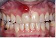 Abscesso dentário o que é, sintomas, causas e tratament